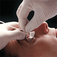 [MD01614/1] Morgan Lens - Individual Sterile Lens x 1